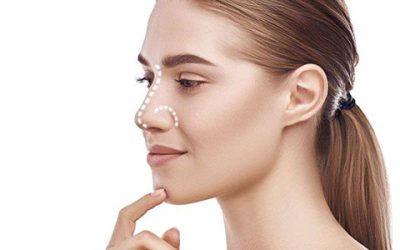 Rinoplastia