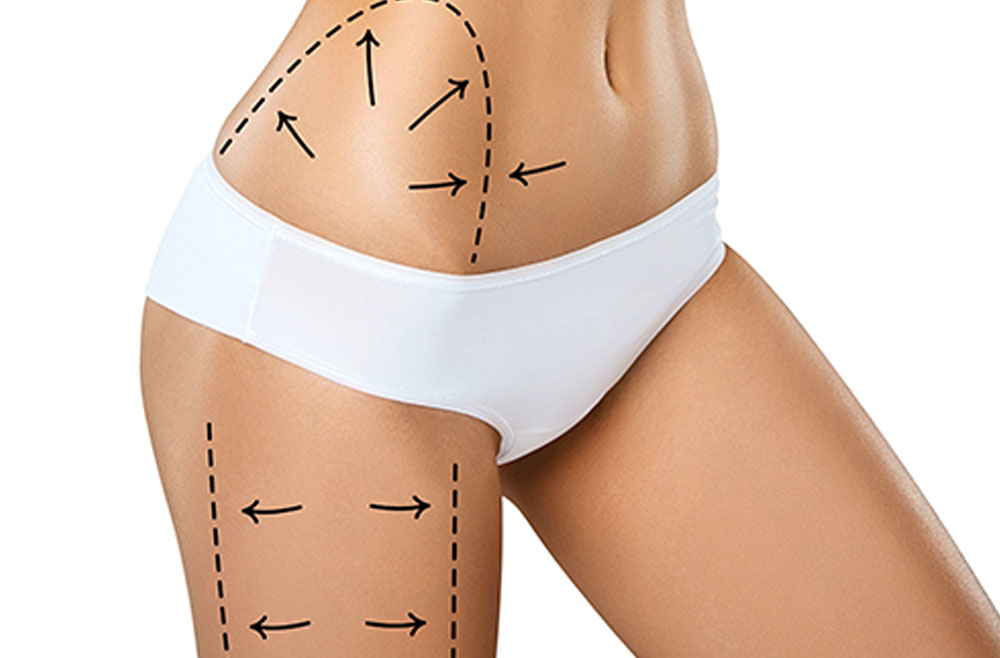 Lipoaspiracion