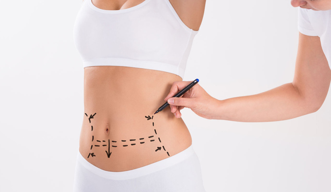 abdominoplastia